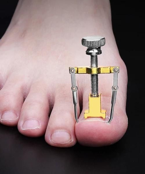 Ingrown ToeNail Fixer Device